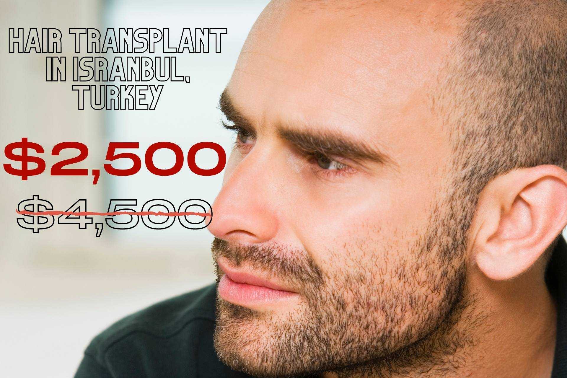 Hair Transplant in Istanbul, Turkey